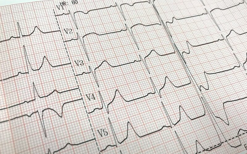 心電図検査